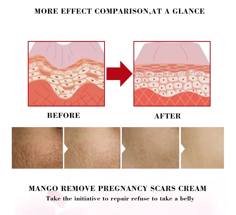 Crema EFERO pentru Vergeturi, Efect de Regenerare Celulara, Redare Elasticitate, Elaimei Stretch Mark