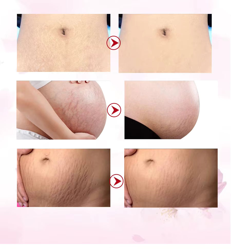 Crema EFERO pentru Vergeturi, Efect de Regenerare Celulara, Redare Elasticitate, Elaimei Stretch Mark
